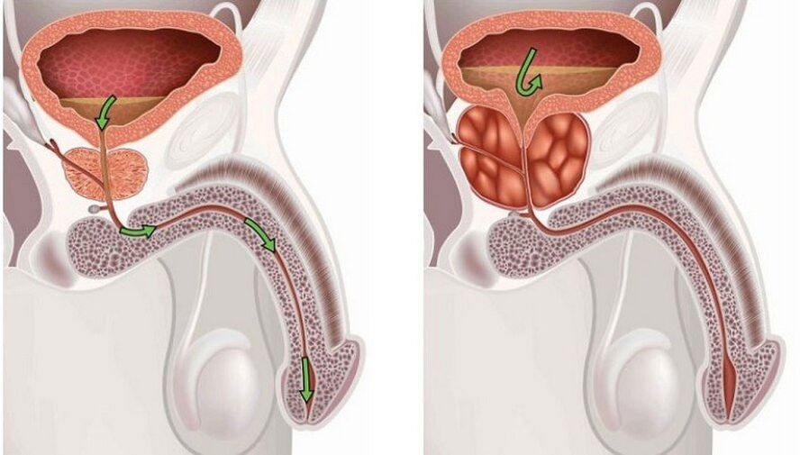 Male prostatitis